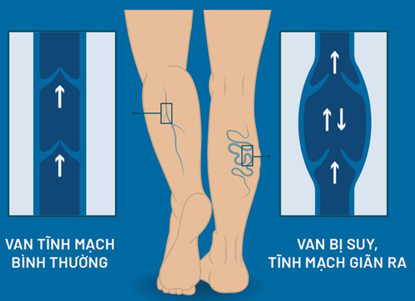 Suy giãn tĩnh mạch chân Bic Nano Cell 