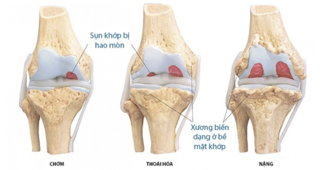 Thoái hóa khớp là gì Bic Nano Cell 