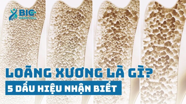 Bệnh loãng xương là gì? dấu hiệu bệnh loãng xương BIC NANO CELL