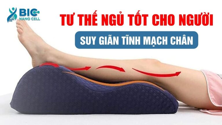 Tư thế ngủ tốt cho người suy giãn tĩnh mạch chân Bic Nano Cell