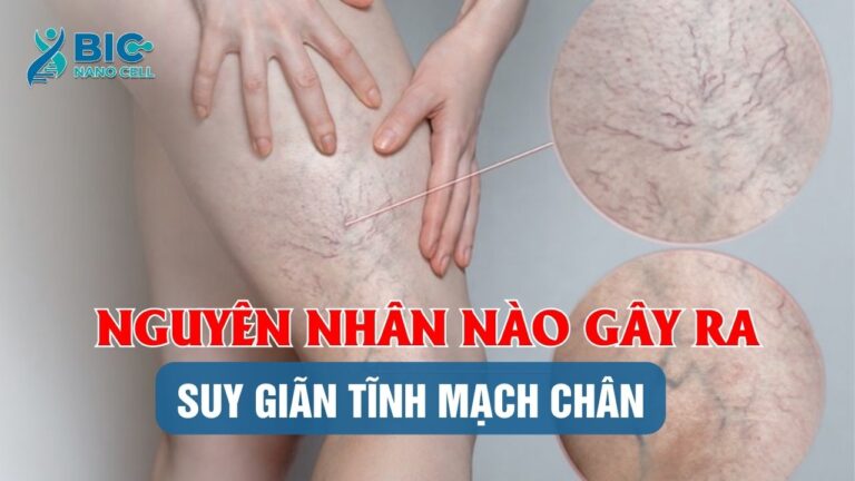 Nguyên nhân gây suy giãn tĩnh mạch chân Bic nano cell