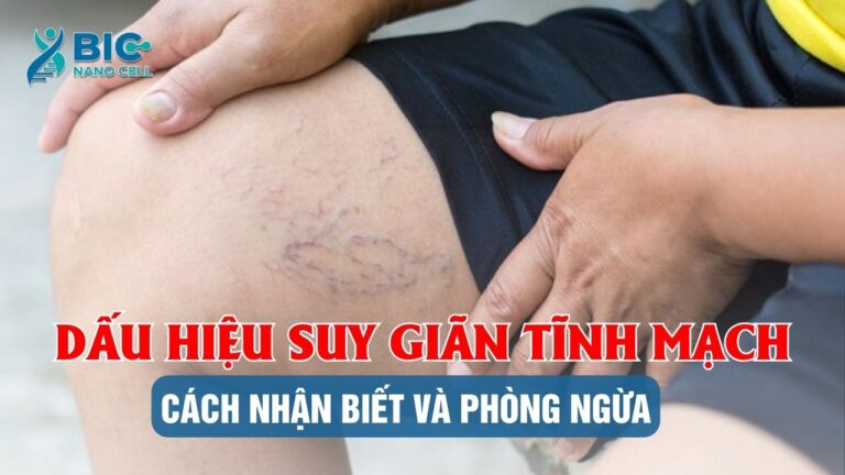 Dấu hiệu suy giãn tĩnh mạch chân Bic Nano Cell