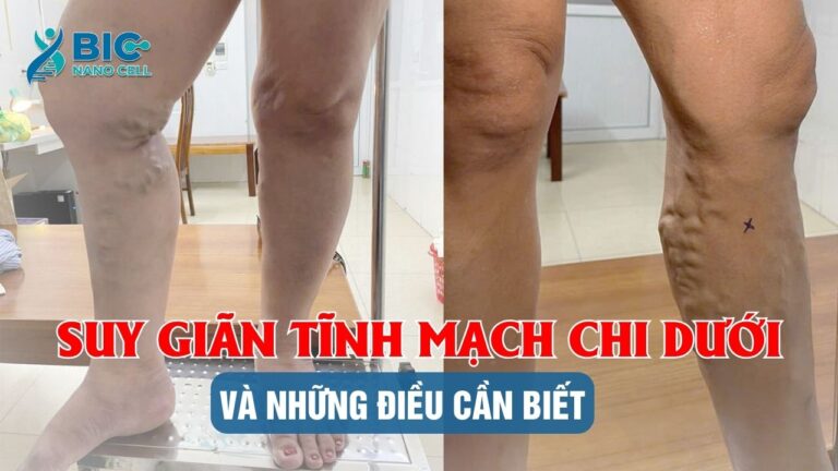 Suy giãn tĩnh mạch chi dưới Bic Nano Cell