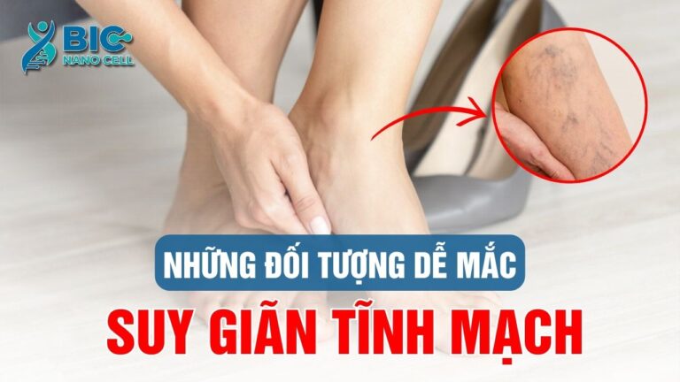 Đối tượng dễ mắc suy giãn tĩnh mạch chân Bic nano cell