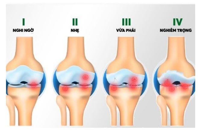 Các giai đoạn thoái hóa khớp gối Bic Nano Cell