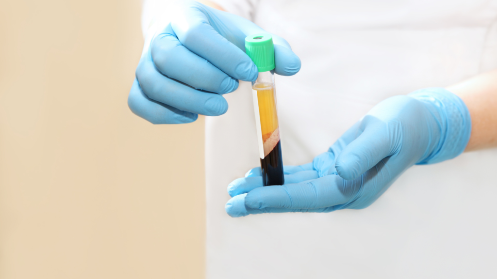 Tiêm PRP điều trị thoái hóa khớp sau bao lâu thì phát huy tác dụng?